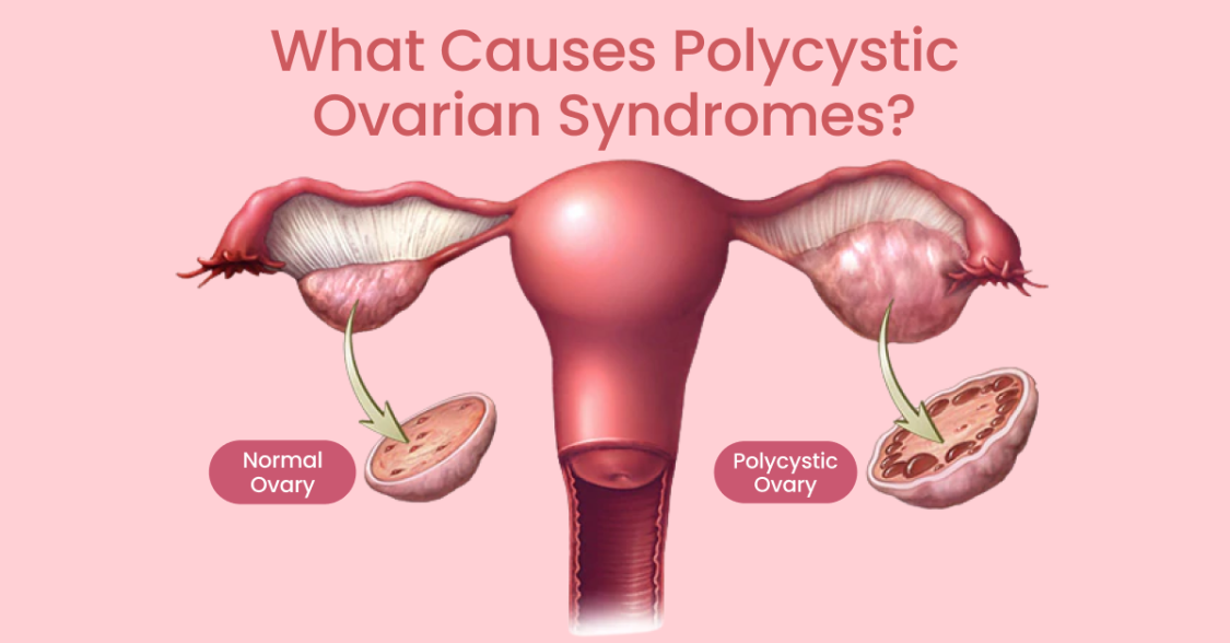 PCOS: Symptoms and Causes